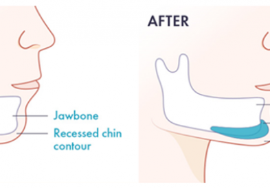 Hiểu rõ phẫu thuật độn cằm