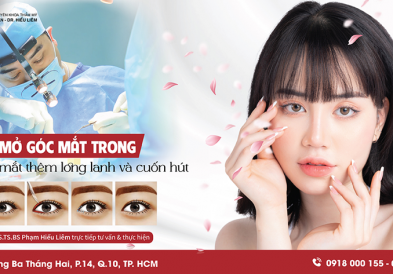 Mở góc mắt trong