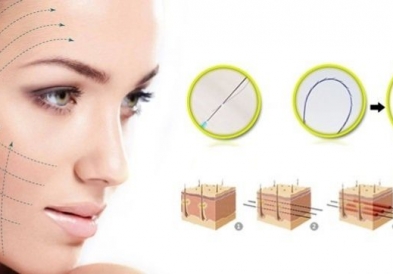 NHỮNG LƯU Ý GÌ SAU KHI CĂNG DA MẶT BẰNG CHỈ