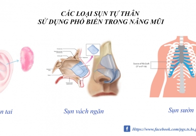 Nâng mũi sụn tự thân hoàn toàn