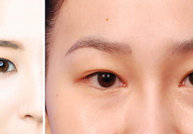 Cách làm mí mắt to