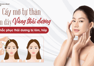 Cấy mỡ tự thân vào thái dương