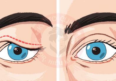 Phẫu thuật nâng cơ mí mắt