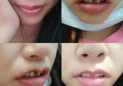 Phẫu thuật thẩm mỹ hỏng vùng khác