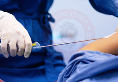 Hút mỡ bắp tay bị lồi lõm