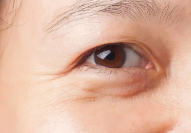 Chỉnh sửa đôi mắt mí lót thành mắt hai mí