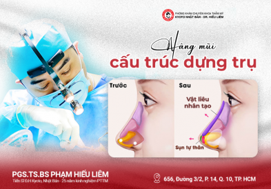 Nâng mũi cấu trúc dựng trụ
