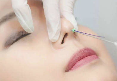 Nâng mũi bằng chỉ có an toàn không?