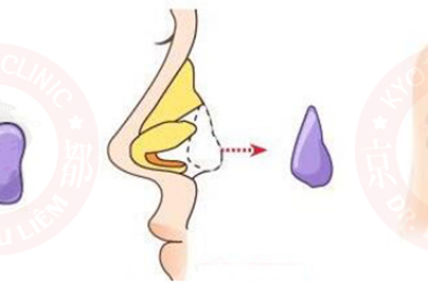 Nâng mũi bằng sụn tự thân có tốt không?