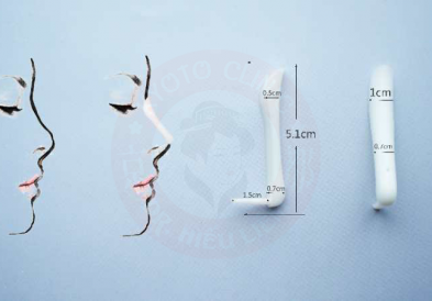 Nâng mũi sụn nhân tạo có vĩnh viễn không?