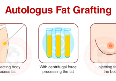Nâng ngực bằng mỡ tự thân
