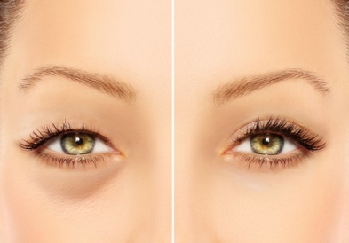 Những kiến thức cần nắm trước khi lấy bọng mỡ mi dưới