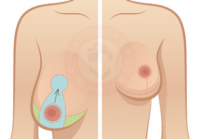 Treo ngực sa trễ không đặt túi