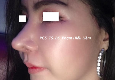Những biến chứng phổ biến sau phẫu thuật thẩm mỹ vùng mũi