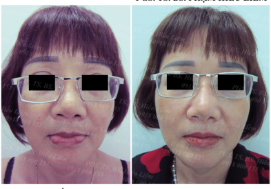 BIẾN CHỨNG TIÊM SILICON LỎNG