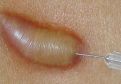 Sẹo lồi là gì ?