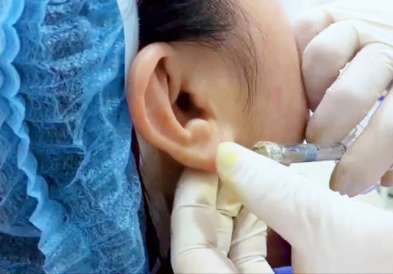 Tạo hình thẩm mỹ dái tai tròn đầy