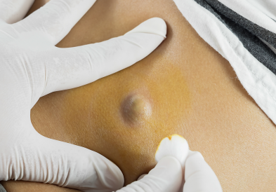 Thông tin cần biết về cắt u bã đậu