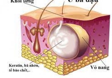 Dấu hiệu nhận biết u bã đậu là gì?